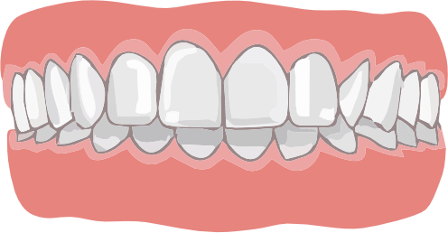 Глубокий прикус