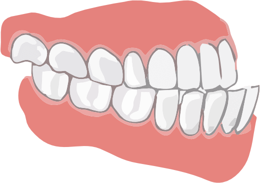 Мезиальный прикус