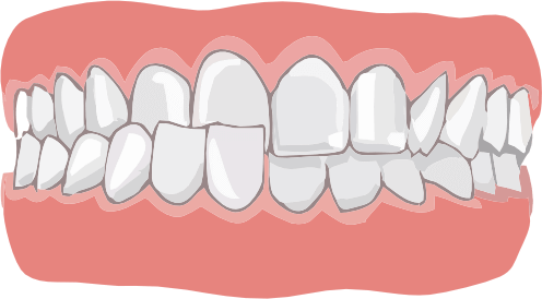 Перекрестный прикус